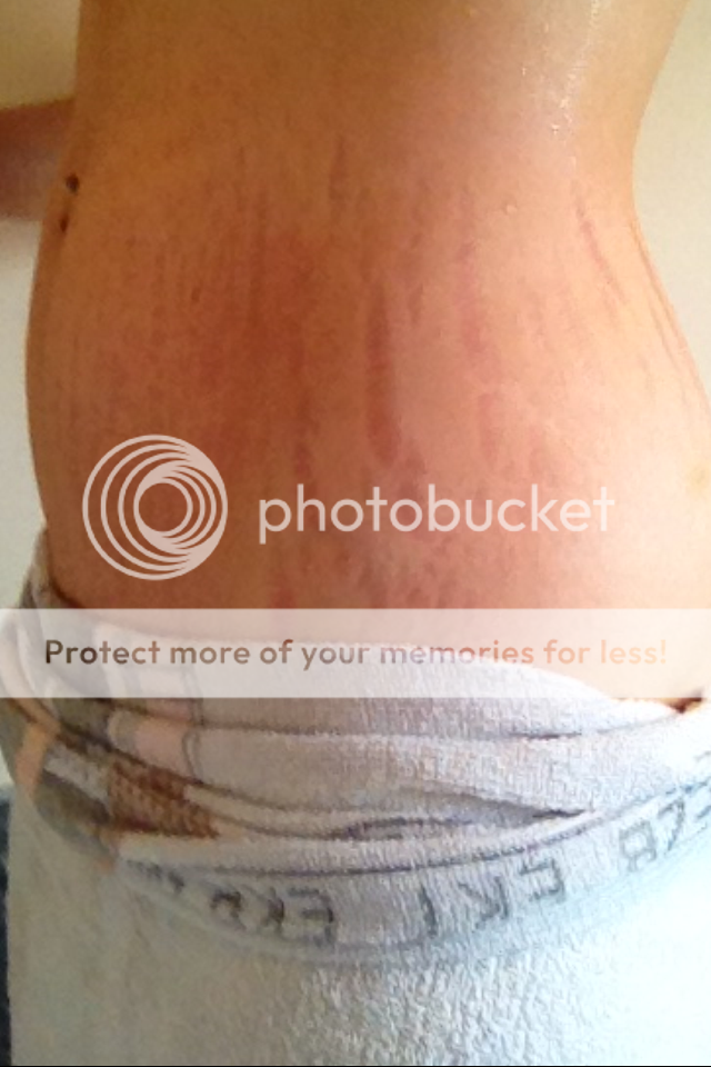 Stretch marks (pic) BabyCentre